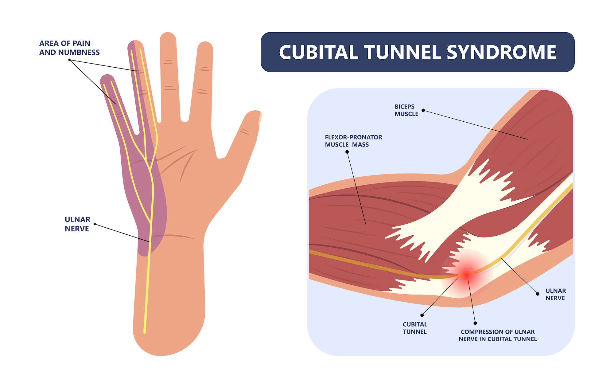 cubital tunnel syndrome baltimore